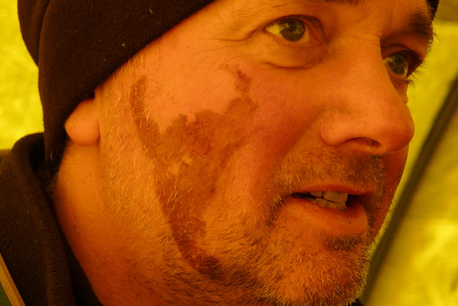 post summit scorpion windburn